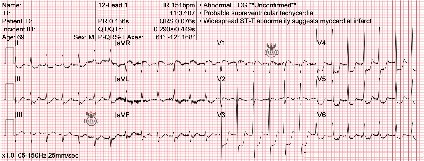 Presenting ECG — EMS ECGs: opportunity to save lives prehospital by recognizing severe hyperkalemia