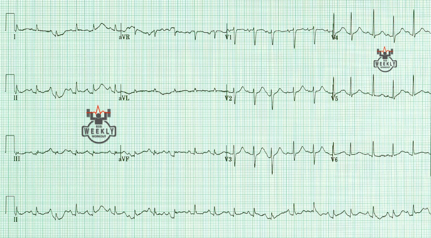 Presenting ECG — ECG Basics & Fundamentals: low voltage QRS complexes and sinus tachycardia