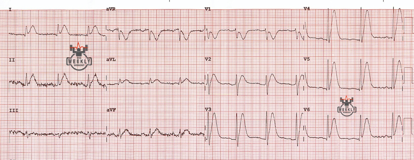 Presenting ECG — Literature Review: cardiovascular complications of cancer therapy