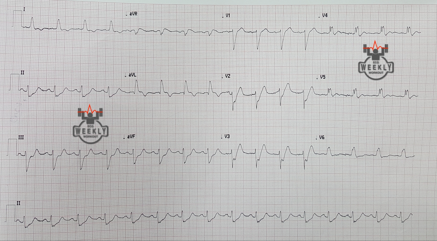 Presenting ECG — STAT ECG Diagnoses: does the presence of a LBBB obviate the ability to diagnose occlusion MI?