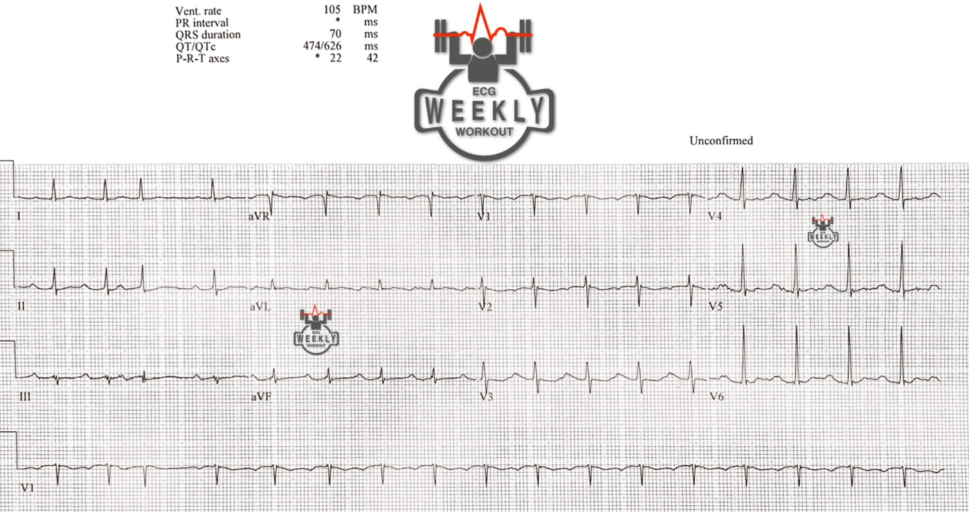 Presenting ECG — Differential Diagnoses: interval abnormalities and the importance of not trusting the computer ECG interpretation