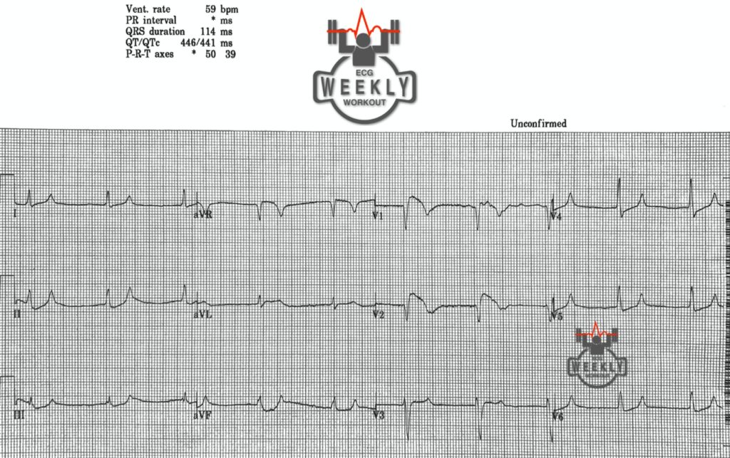 Presenting ECG — Differential Diagnoses: new right axis deviation and ST segment elevation