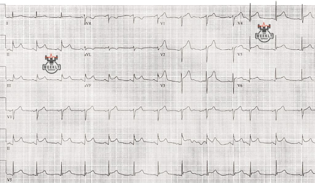 Presenting ECG — Differential Diagnoses: factors that rule in STEMI in the evaluation of diffuse ST segment elevation