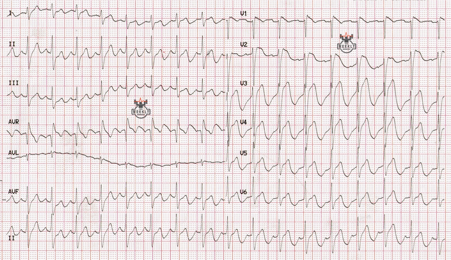 Presenting ECG — STAT ECG Diagnoses: Brugada ECG pattern vs. Brugada syndrome