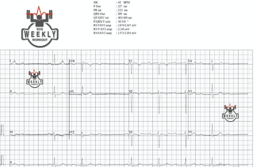 Presenting ECG — Rhythm Interpretation: never trust the computer interpretation and scrutinize every lead