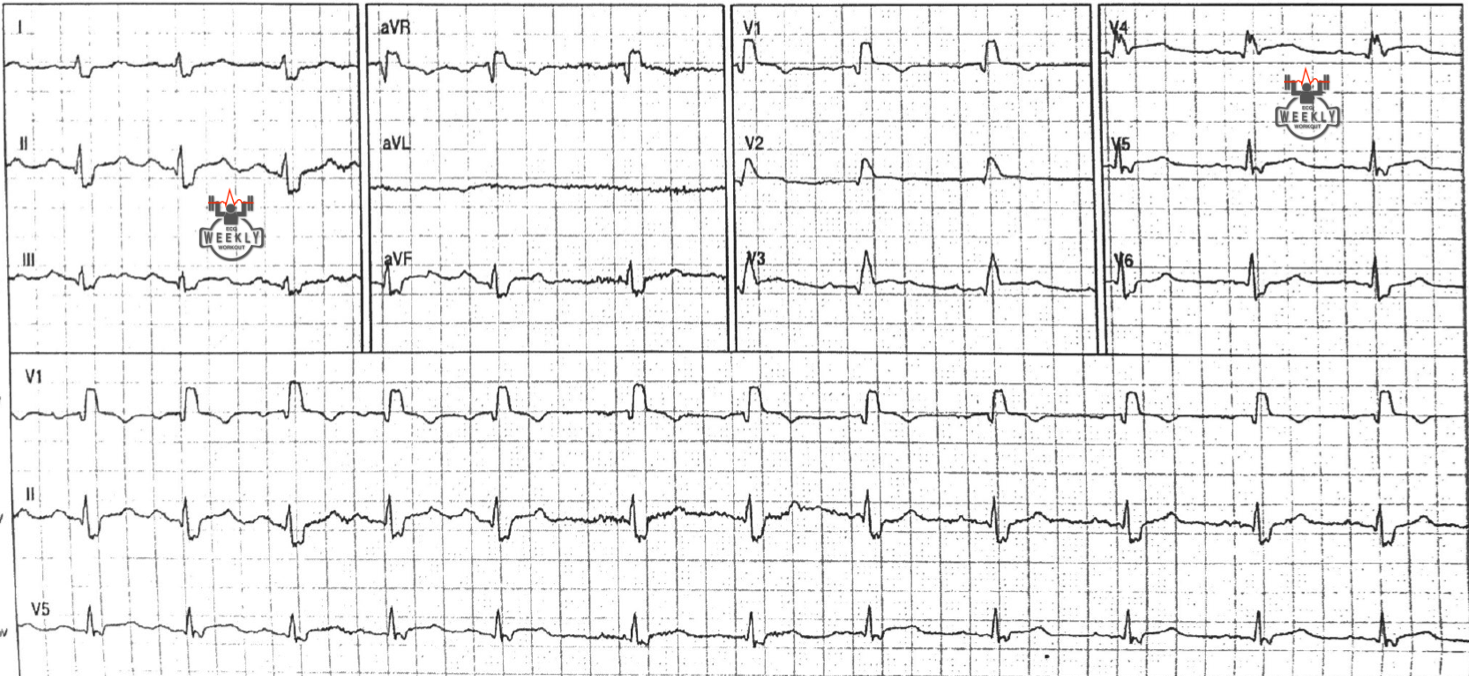 Presenting ECG — ECG Basics & Fundamentals: normal and expected findings in right bundle branch block (RBBB) vs patients with occlusion MI