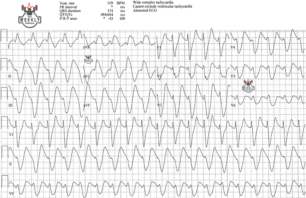 Presenting ECG — STAT ECG Diagnoses: the great immitator strikes again in a case of wide complex tachycardia