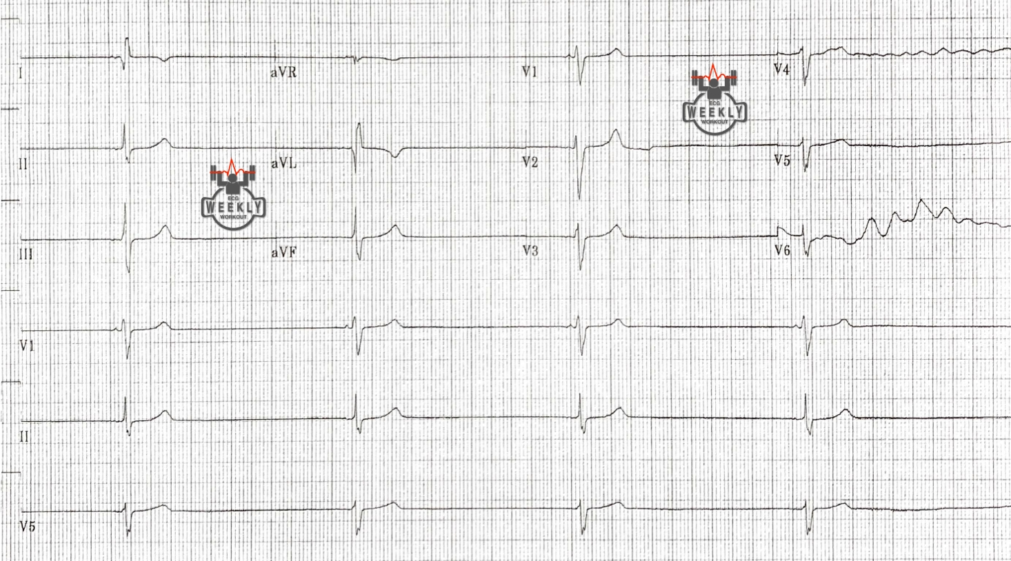 Presenting ECG — STAT ECG Diagnoses: bradycardia, renal failure, AV nodal blockade, shock, and hyperkalemia