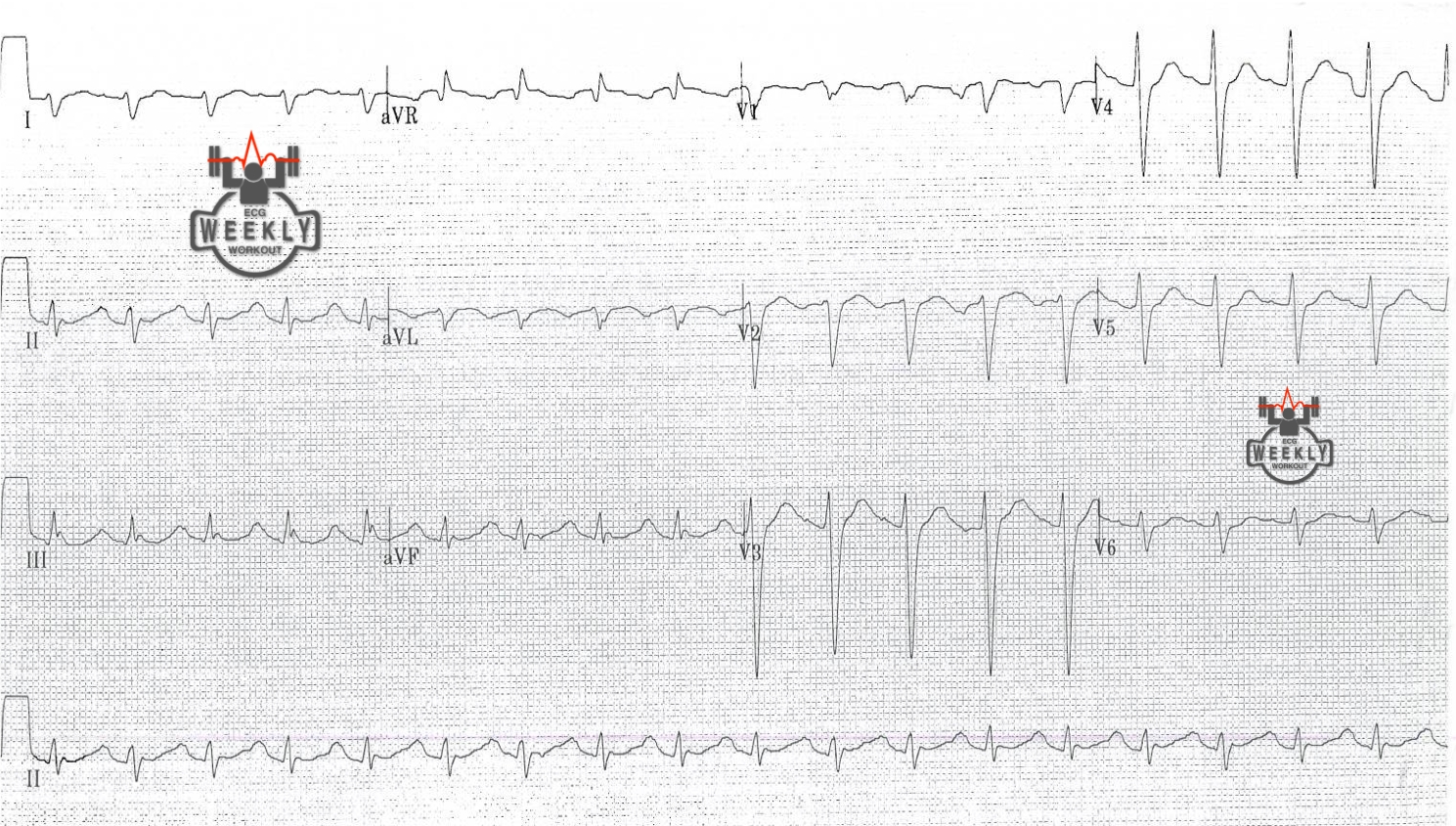 Presenting ECG — STAT ECG Diagnoses: how to use ECG differentials to clinc the diagnosis in patients who are altered and can not provide a reliable history