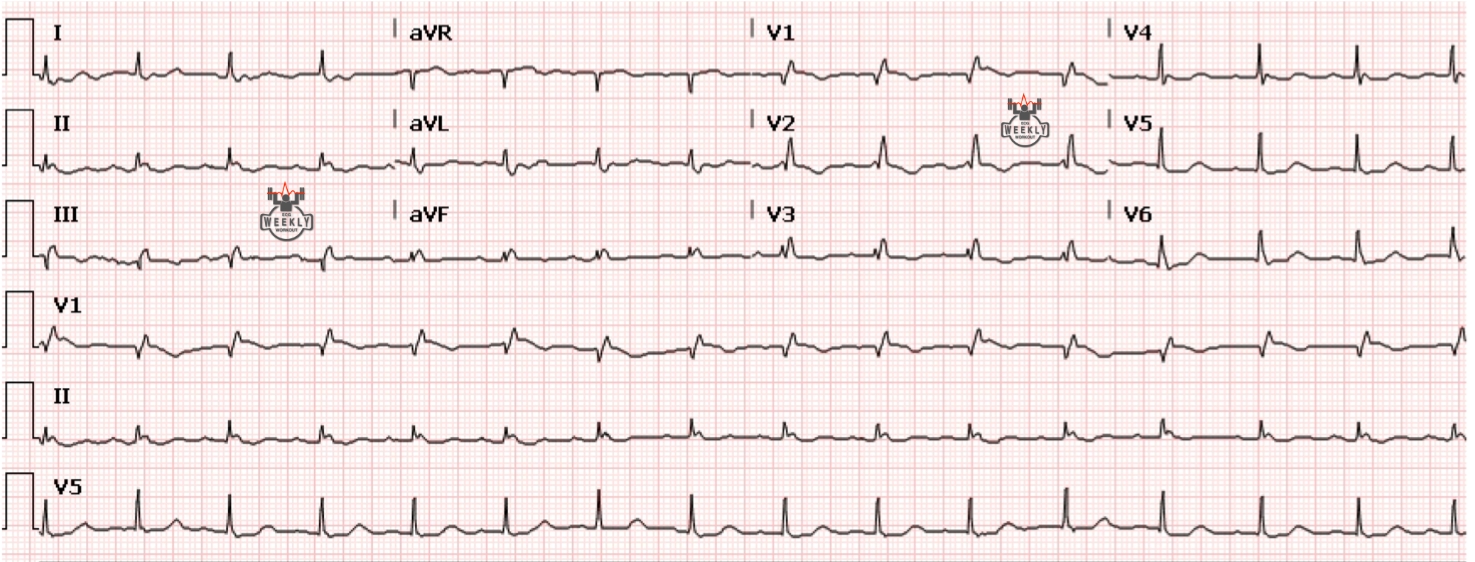 Presenting ECG — ECG Basics & Fundamentals: interval abnormalities can cause clinical uncertainty