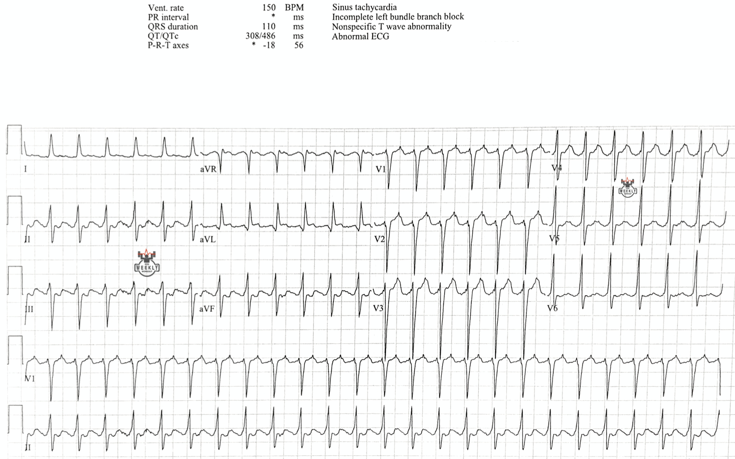 Presenting ECG — Differential Diagnoses: narrow complex regular tachycardias