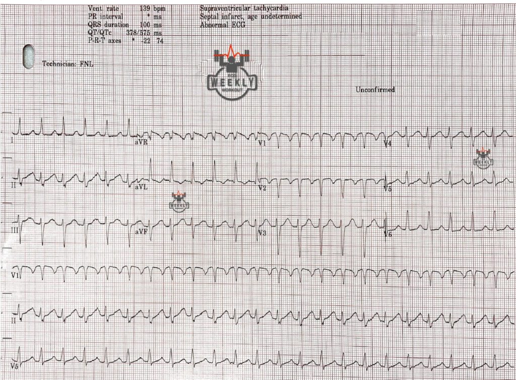 Presenting ECG — Literature Review: COVID and the Heart