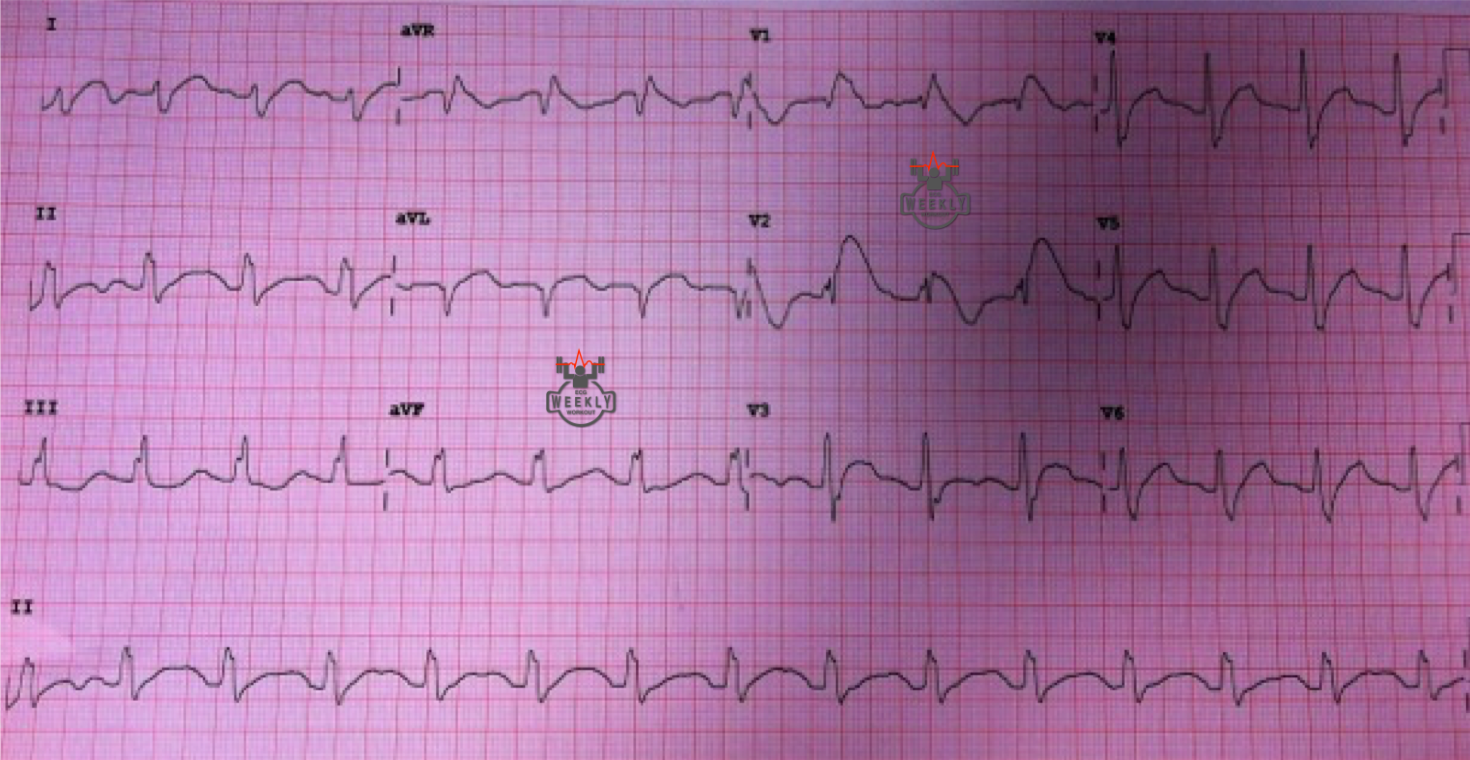 Presenting ECG — ECG Basics and Fundamentals: A stepwise approach to ECG interpretation and how to use differential diagnoses to make critical clinical diagnoses