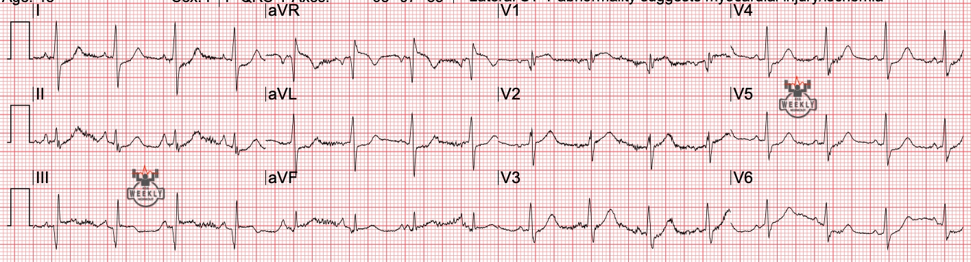 Presenting ECG — ECG Basics and Fundamentals: right axis deviation differential and ST segment elevation in rightward leads