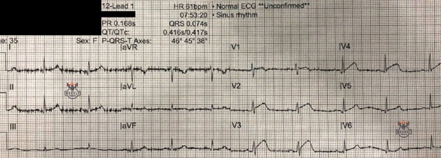 Presenting ECG — ECG Basics & Fundamentals: how reliable are reciprocal changes in the diagnosis of STEMI and identication of acute coronary occlusion MI?