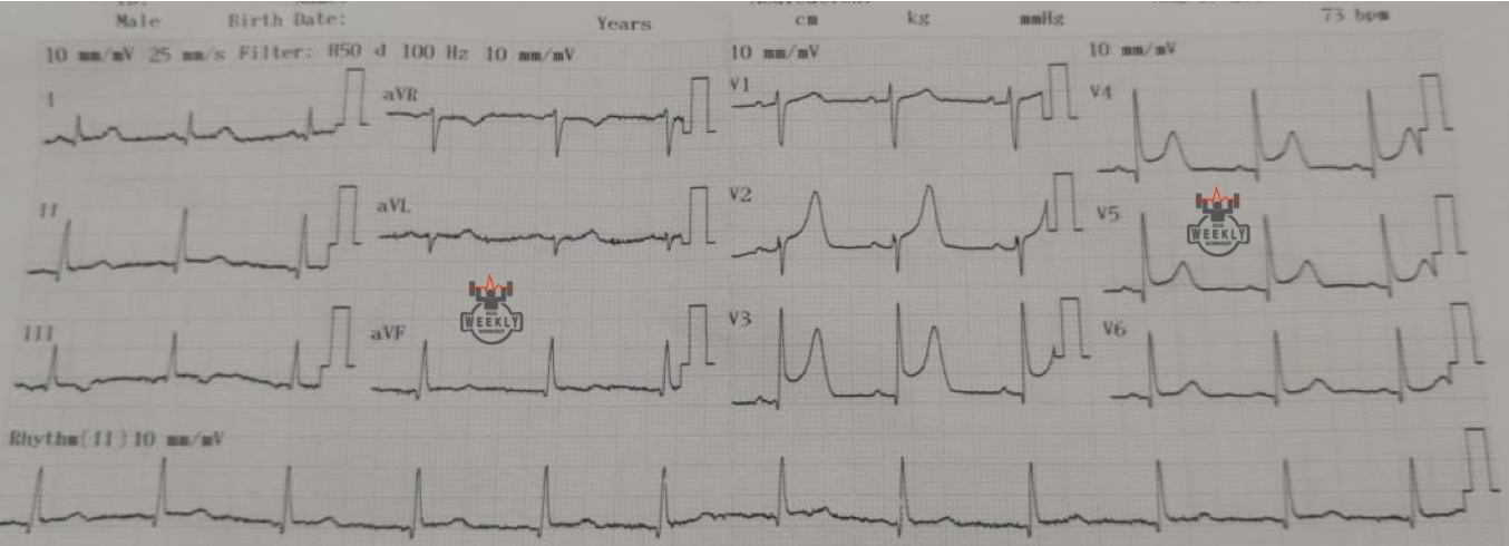 Presenting ECG — STAT ECG Diagnoses: are you activating the cath lab for a large STEMI or is this just early repolarization