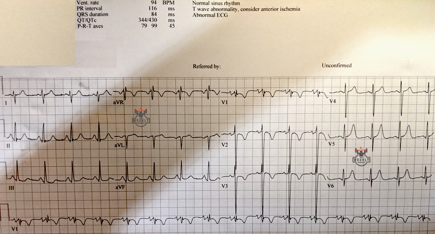 Presenting ECG — STAT ECG Diagnoses: ECG findings of cardiac syncope, what you need to look for what you can't miss!