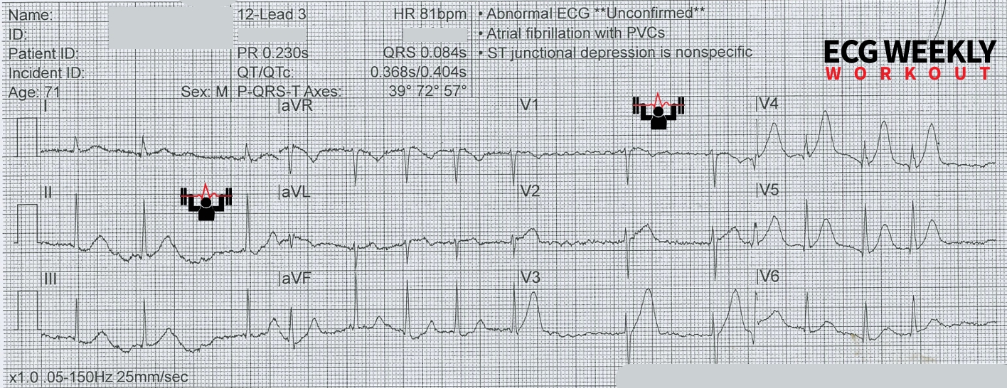 Presenting ECG — STAT ECG Diagnoses: why you should never trust the computer ECG interpretation, even when it reads “normal ECG”!