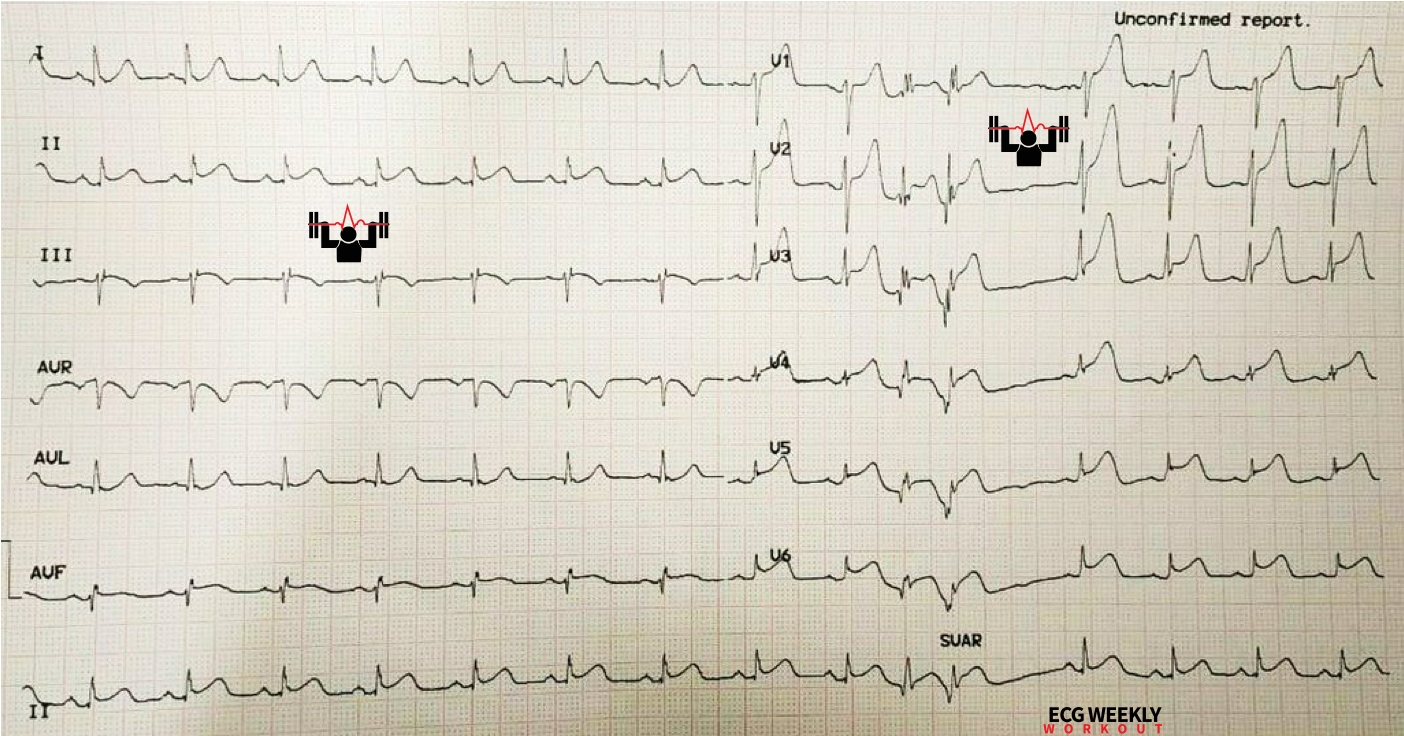 Presenting ECG — Differential Diagnoses: diffuse ST segment elevation without reciprocal ST segment depression