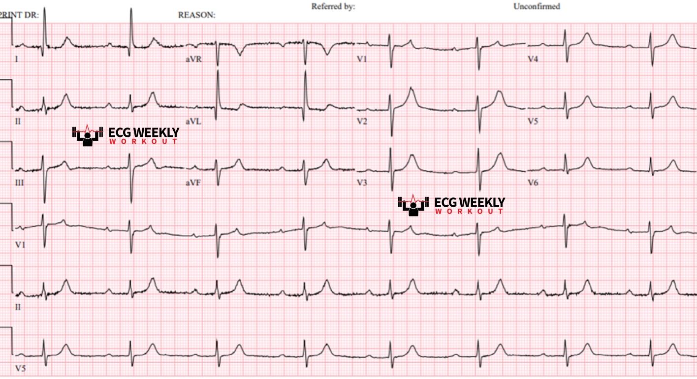 Presenting ECG — AV Block Bootcamp (Episode 3/3): the answer lies in the PR interval!
