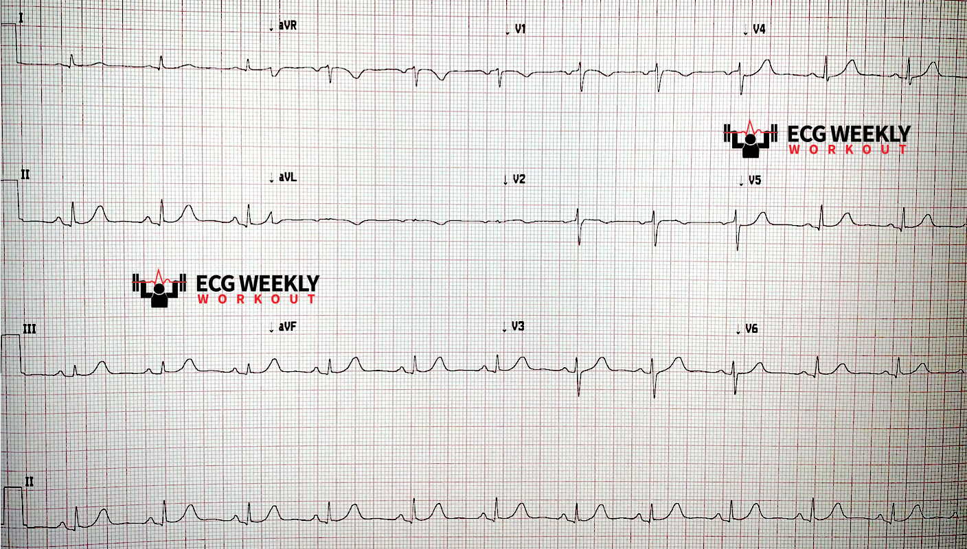 Presenting ECG — STAT ECG Diagnoses: what is the signifcance of a new T wave inversion in aVL?