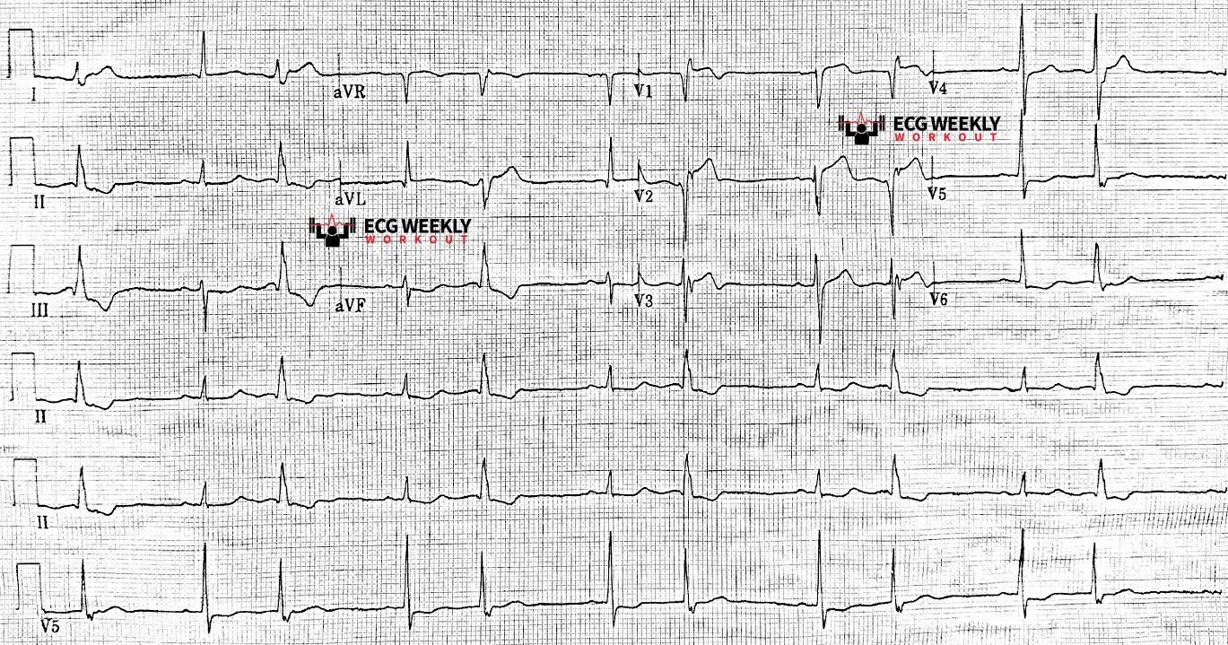 Presenting ECG — STAT ECG Diagnoses: QRS fragmentation and attention to ecopic beats to help diagnose acute cardiac ischemia on the ECG