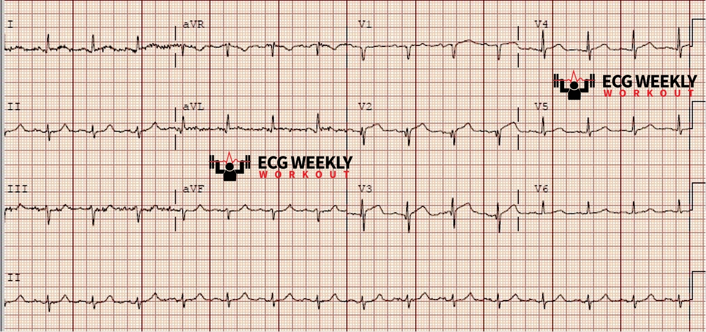 Presenting ECG — Literature Review: QRS fragmentation and pseudonormalization of T waves