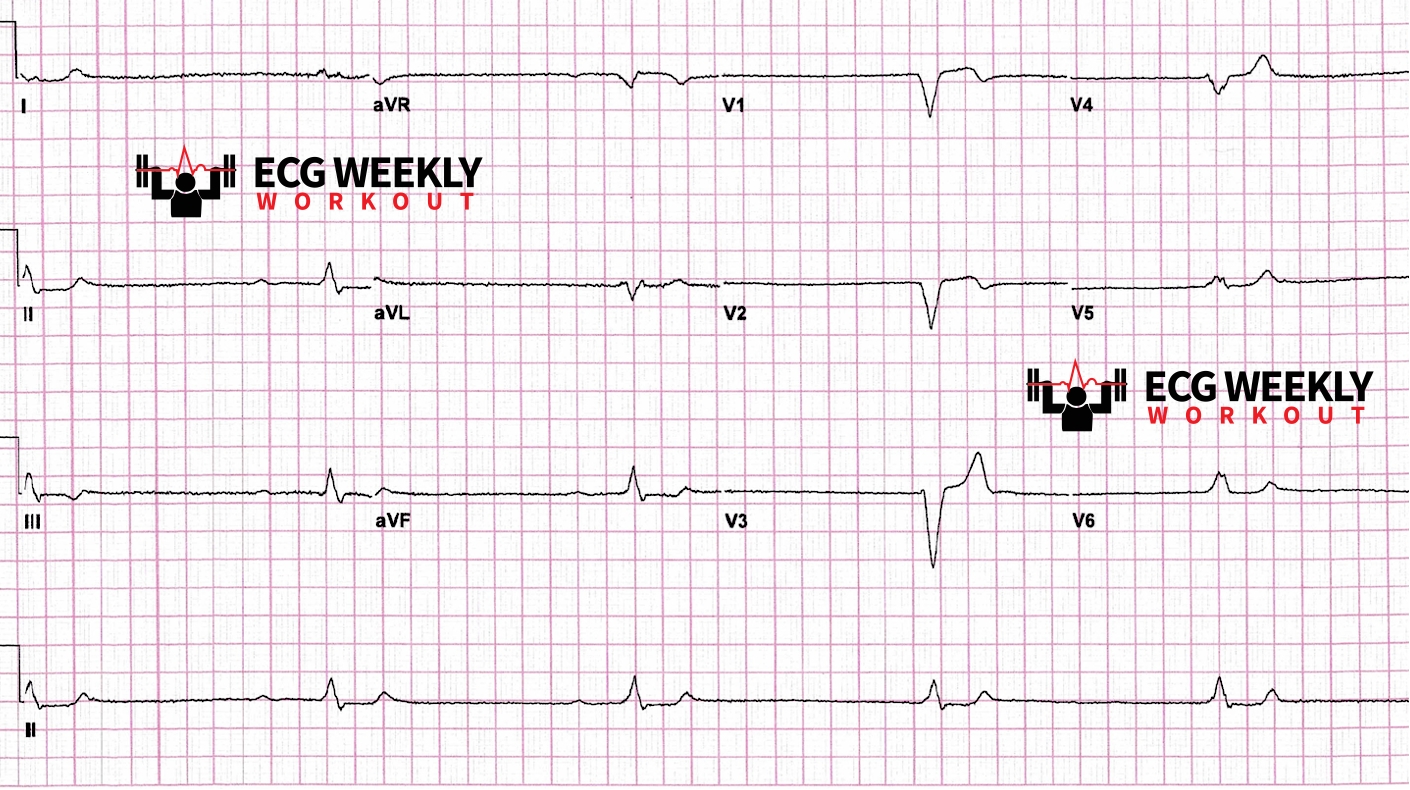 Presenting ECG — STAT ECG Diagnoses: ECG findings of digoxin effect vs. digoxin toxicity