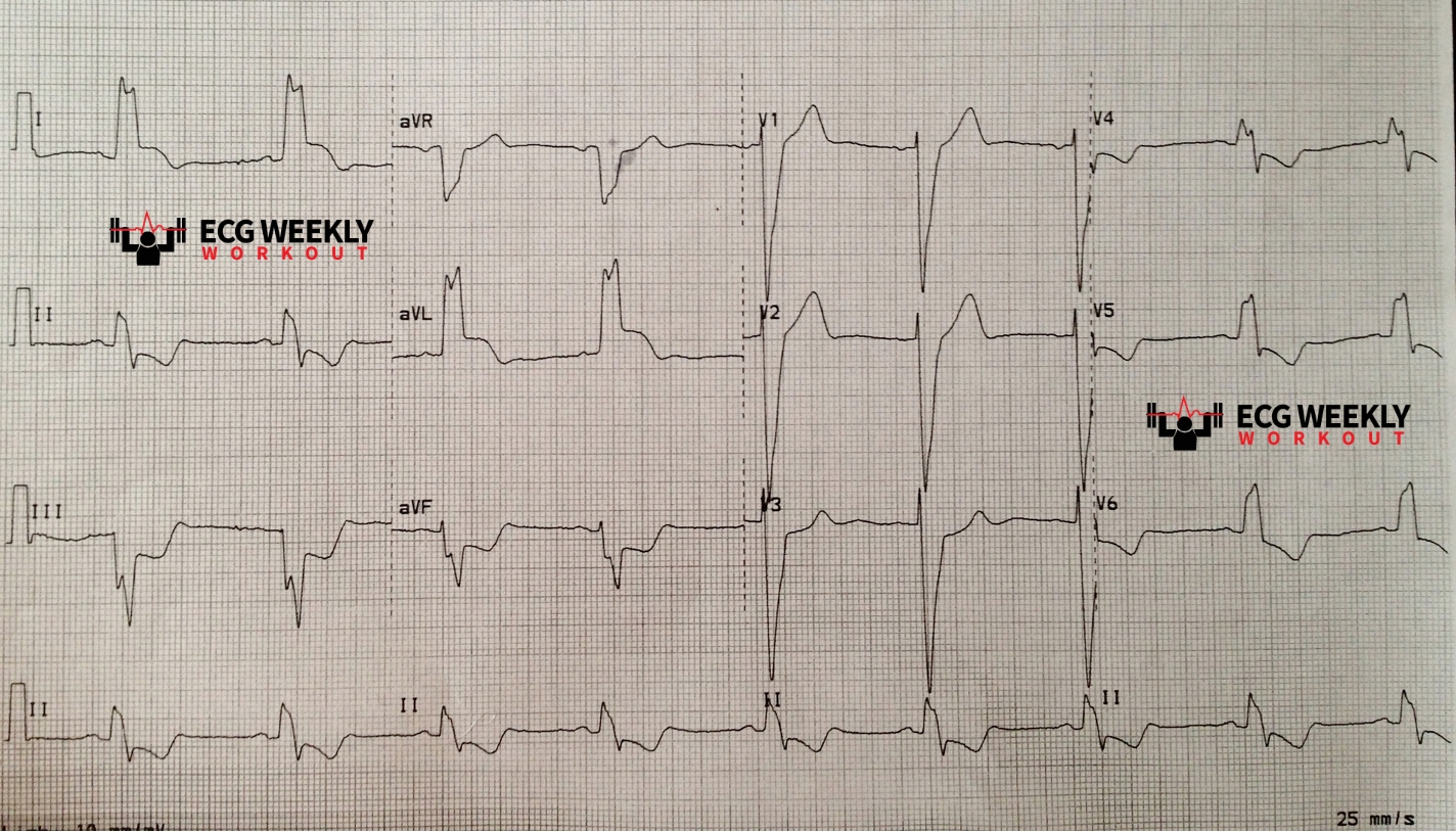 Presenting ECG — STAT ECG Diagnoses: left bundle branch block (LBBB) basics and expected findings with a focus on how to diagnose acute coronary occlusion myocardial infarction in these patients