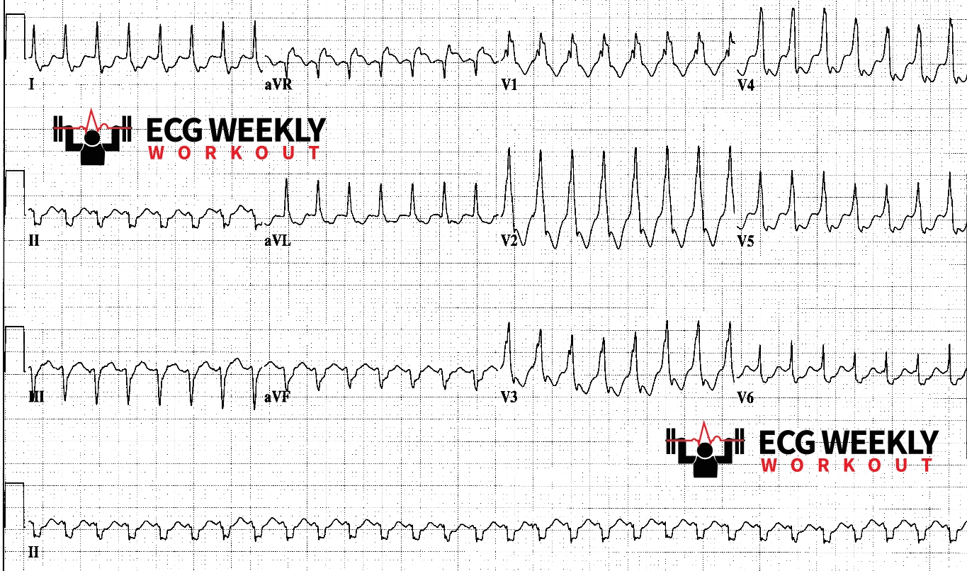 Presenting ECG — Literature Review: pearls and pitfalls in the ECG diagnosis for ventricular tachycardia