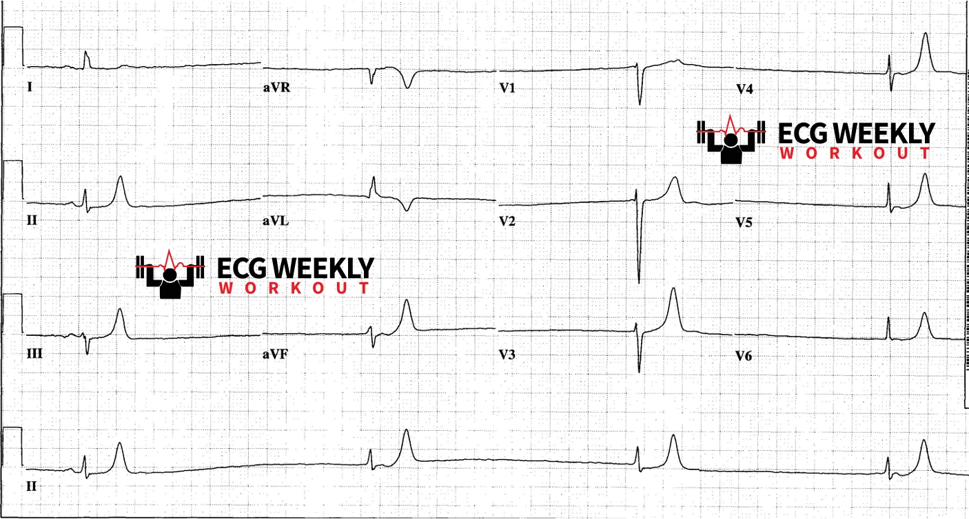 Presenting ECG — Bradyarrhythmias: what to consider when an unstable bradycardia is not reponding to standard ACLS treatments