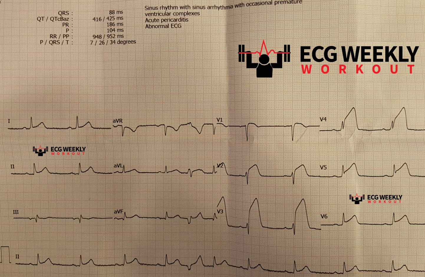 Presenting ECG — STEMI vs. Pericarditis: Recognizing the Dangerous Mimic