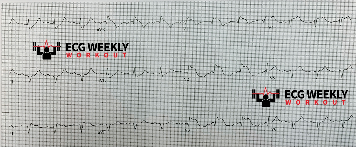 Presenting ECG — STAT ECG Diagnoses: STEMI mimics and how you can use the QRS axis to clinch the diagnosis in patients with altered mental status