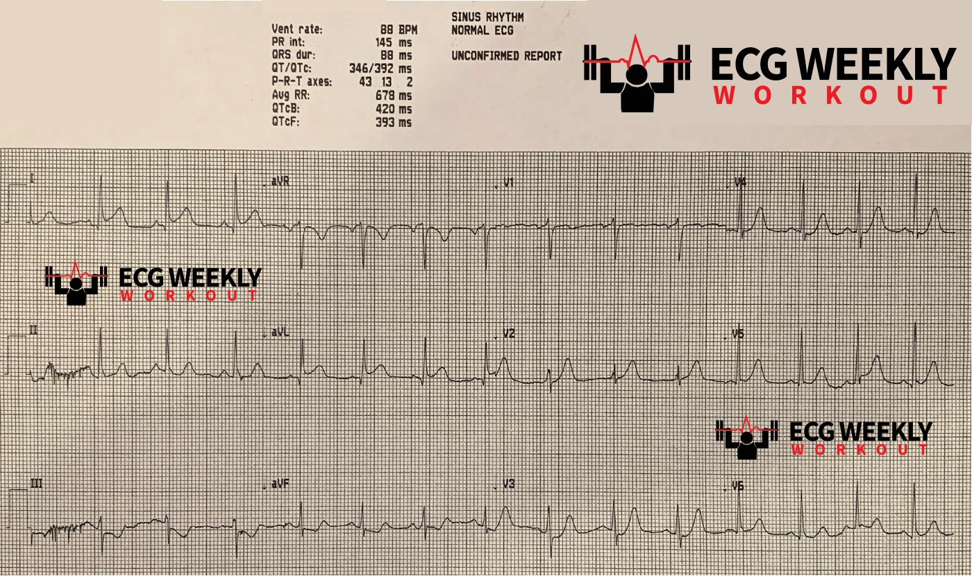 Presenting ECG — Potpourri of cases: BRASH syndrome, the ECG findings in patients of digoxin, and so much more