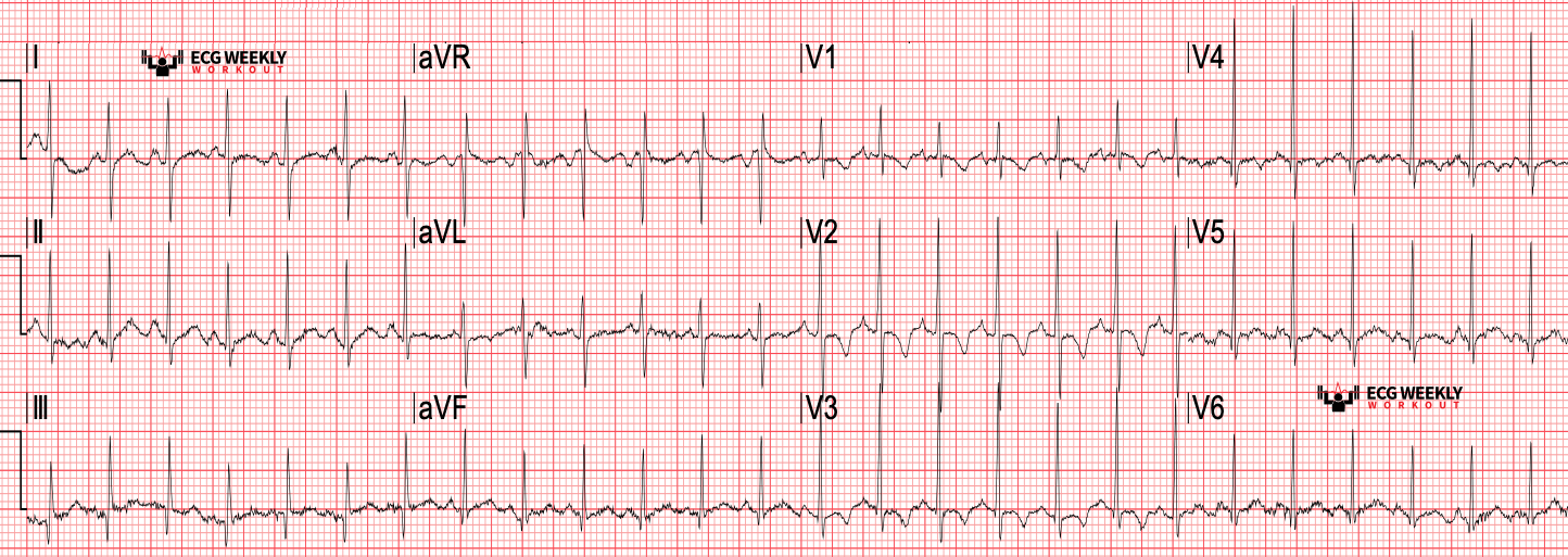 Presenting ECG — ECG Basics and Fundamentals: normal pediatric ECGs and how they differ from normal adult ECGs