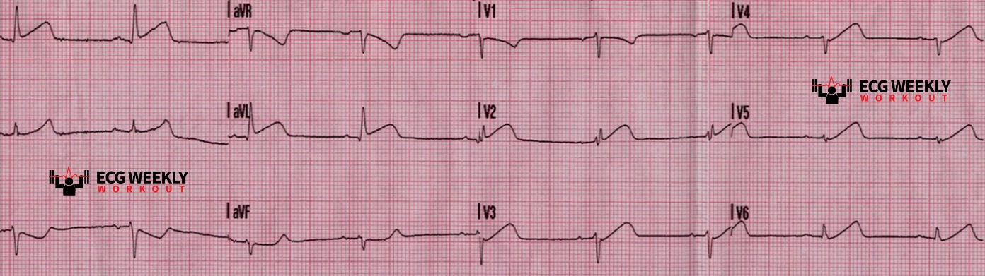 Presenting ECG — Literature Review: subtle early signs of cardiac ischemia and the value of serial ECGs in patients being evaluated for acute coronary syndromes (ACS)