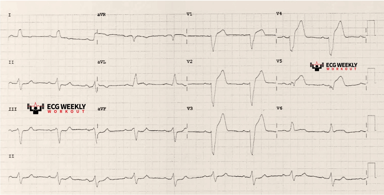 Presenting ECG — ECG Basics and Fundamentals: the basics of left bundle branch block (LBBB) and how to diagnose acute coronary occlusion myocardial infarction in these patients
