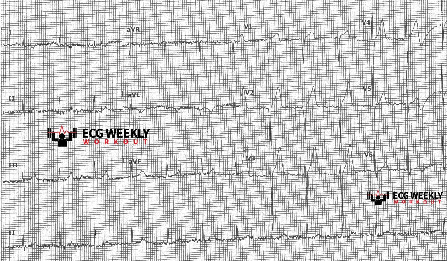 Presenting ECG — Literature Review: mechanisms of acute coronary syndromes (ACS) and the problems with stress testing and coronary angiography