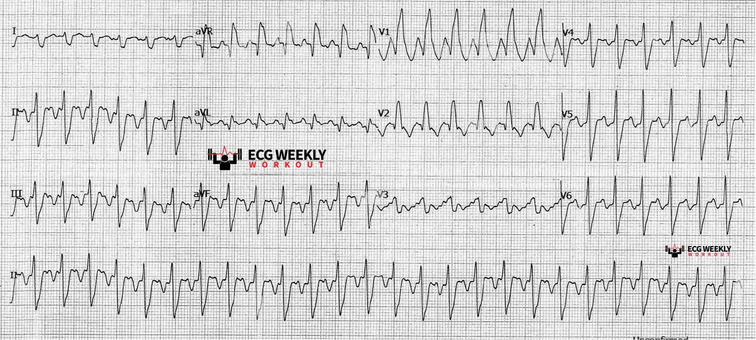 Presenting ECG — Wide Complex Tachycardias: What is the Lewis lead and how you can use modified ECG leads to help make the diagnosis