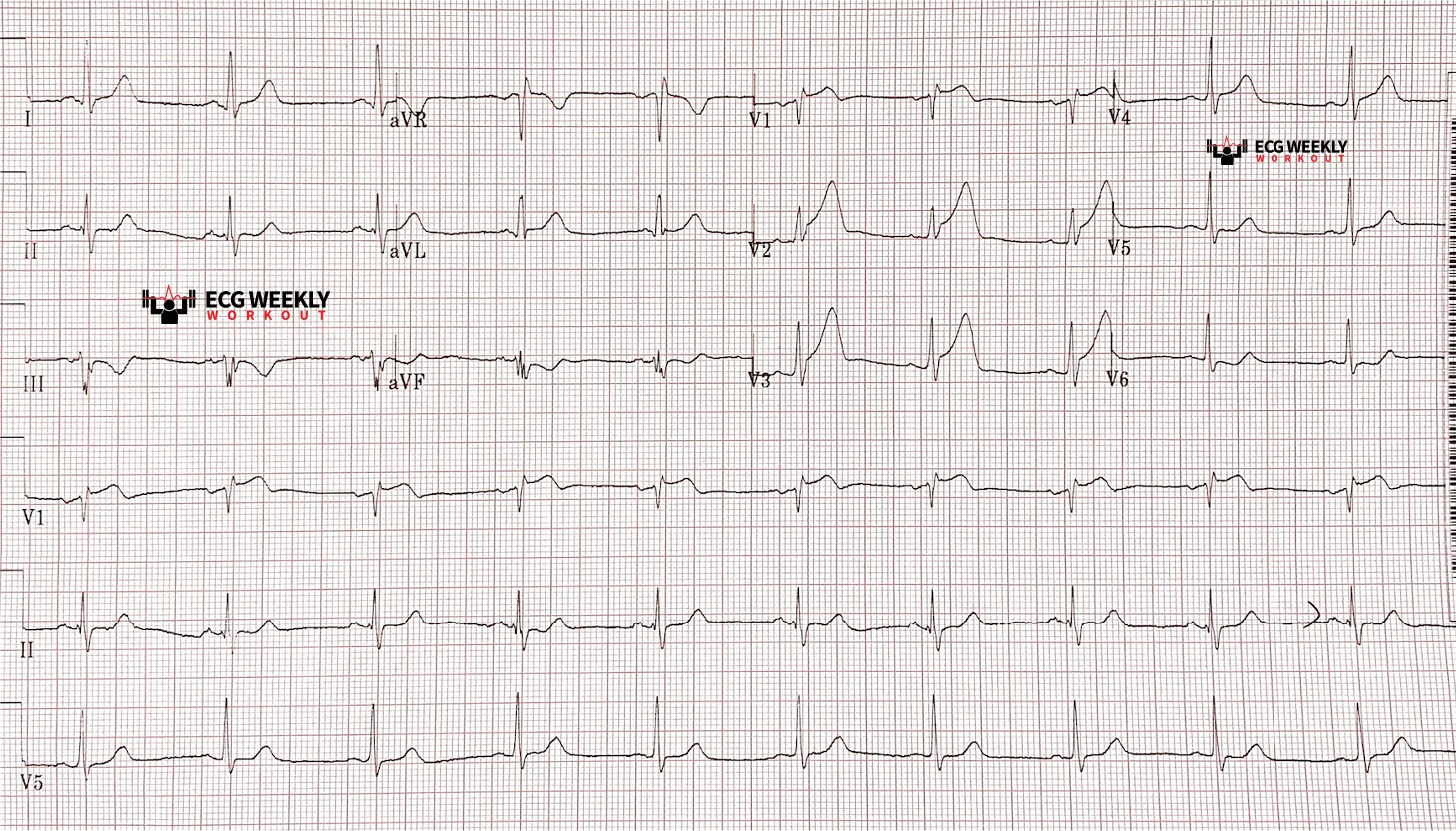 Presenting ECG — STAT ECG Diagnoses: is this ST segment elevation due to early repolarization or a large STEMI?