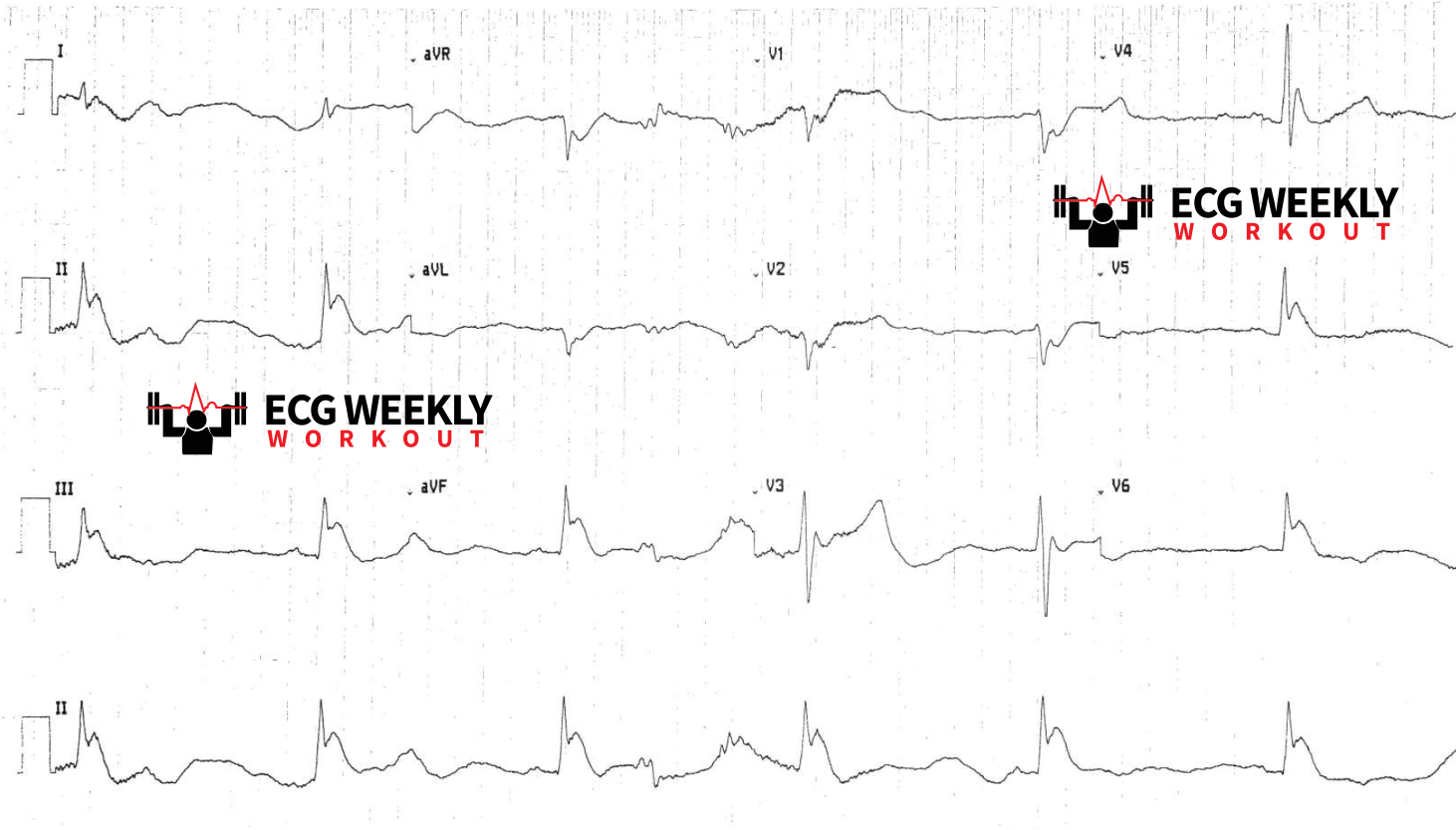 Presenting ECG — STAT ECG Diagnoses: ECG findings that can help you clinch the diagnosis in patients with altered mental status