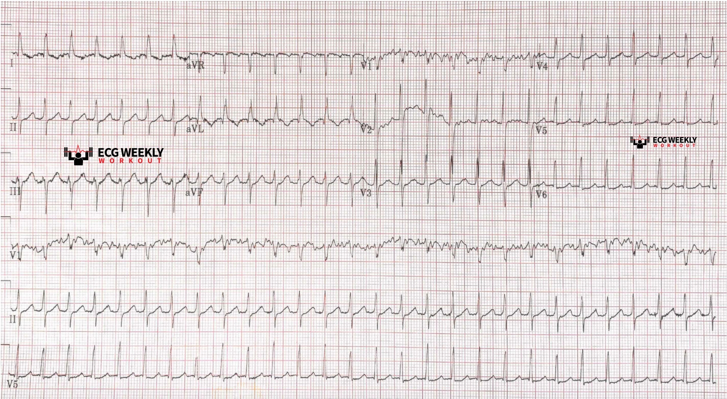 Presenting ECG — Narrow Complex Tachycardia: the maximum achievable sinus heart rate