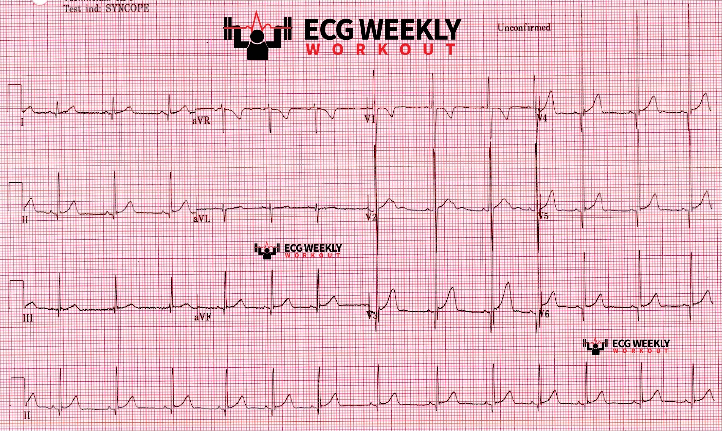 Presenting ECG — STAT ECG Diagnoses: a pediatric patient with syncope and an abnormal ECG