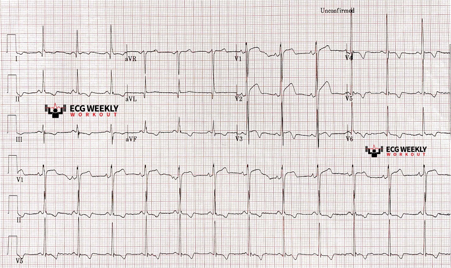 Presenting ECG — Differential Diagnoses: T wave inversions and a discussion about Wellens syndrome