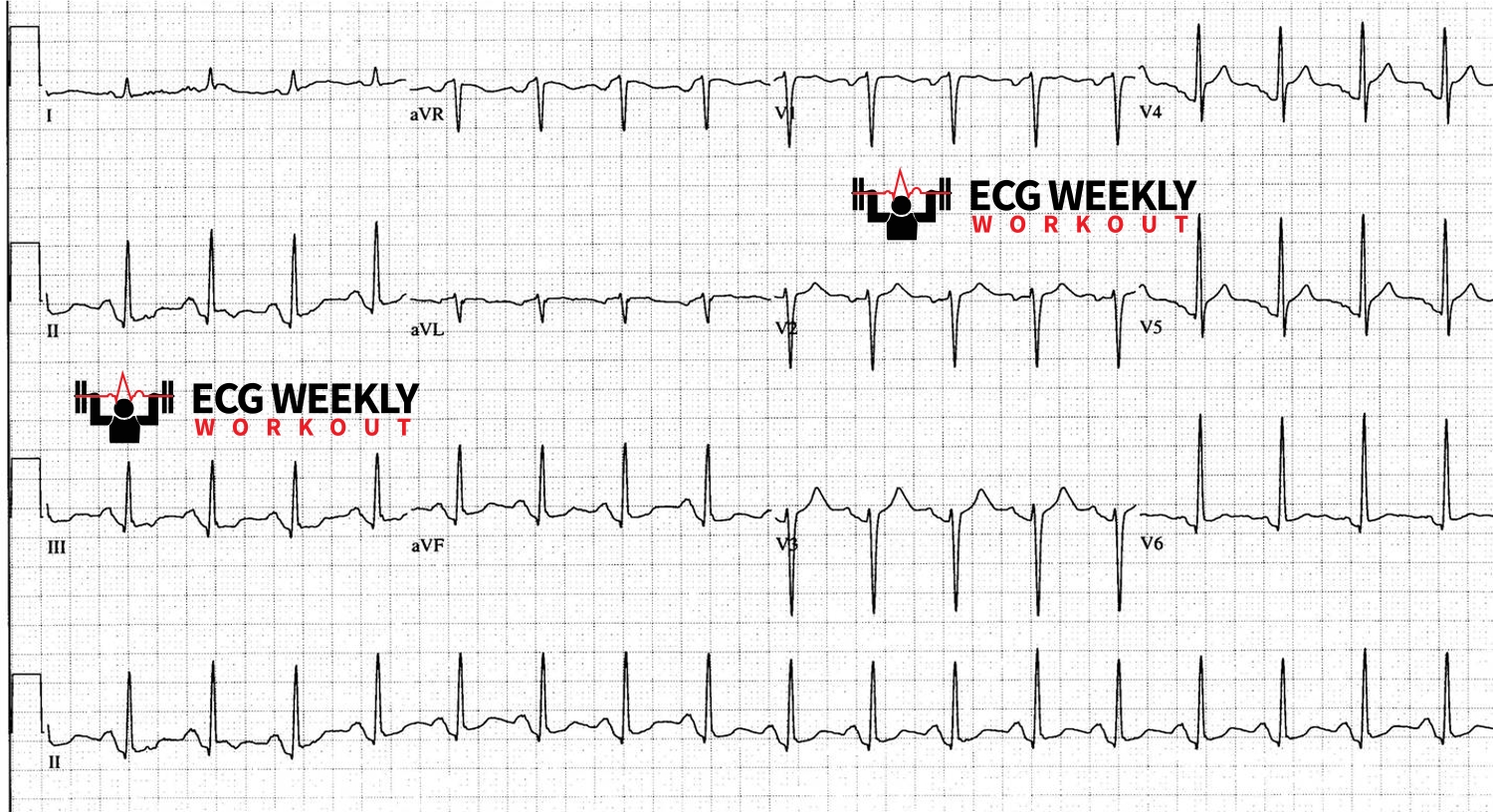 Presenting ECG — ECG Basics and Fundamentals: the isoelectric baseline used to evaluate ST segment deviation
