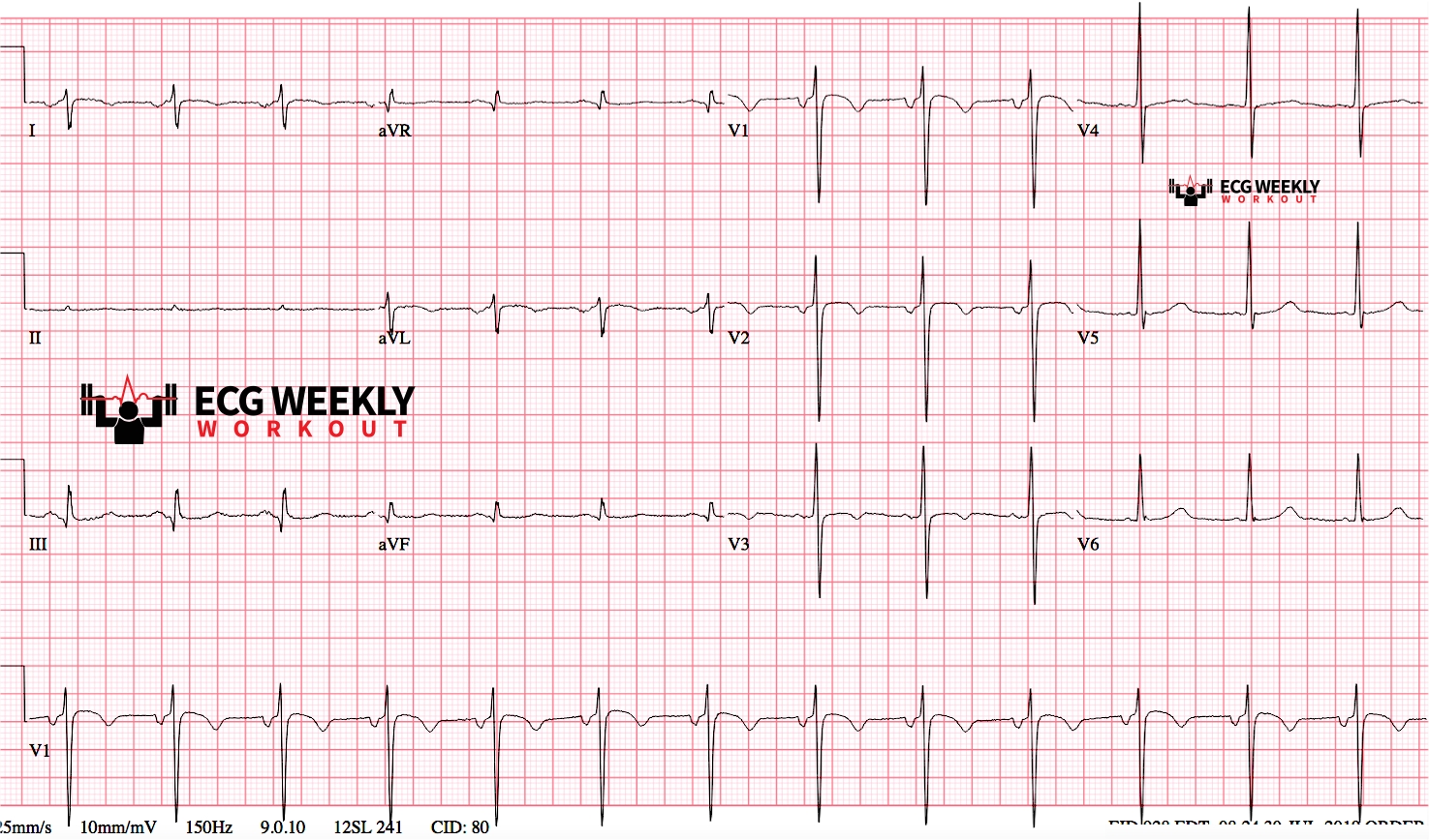 Presenting ECG — ECG Basics and Fundamentals: Limb Lead Reversal