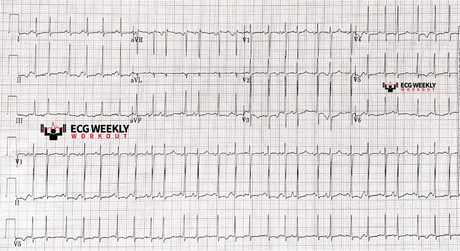 Presenting ECG — STAT ECG Diagnoses: when to cardiovert narrrow complex irregular tachycardias