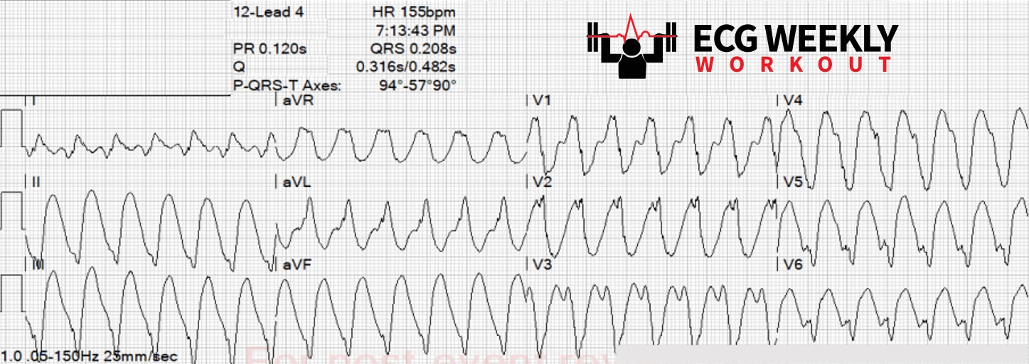 Presenting ECG — STAT ECG Diagnoses: knowing what you are looking for when differentiating the different types of regular wide complex tachycardias