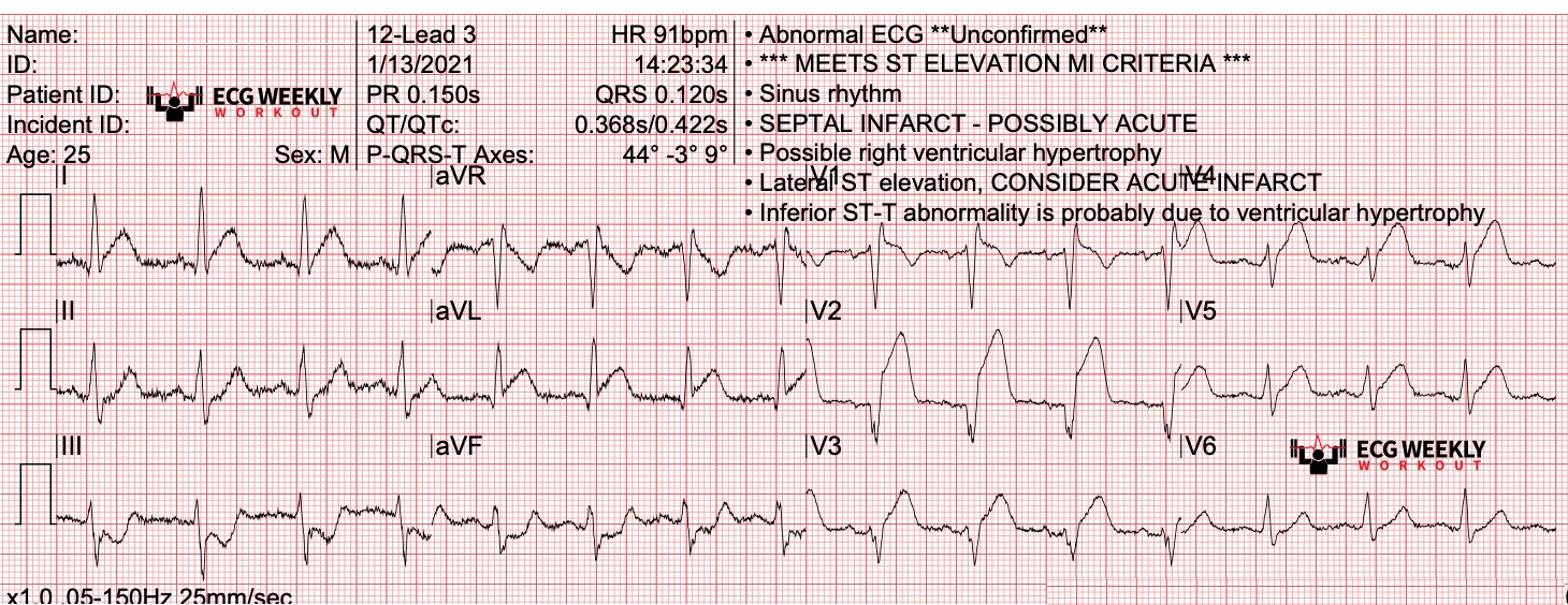 Presenting ECG — Literature Review: cardiac risk factors and the risk of myocardial infarction (MI) in habitual marijuana use