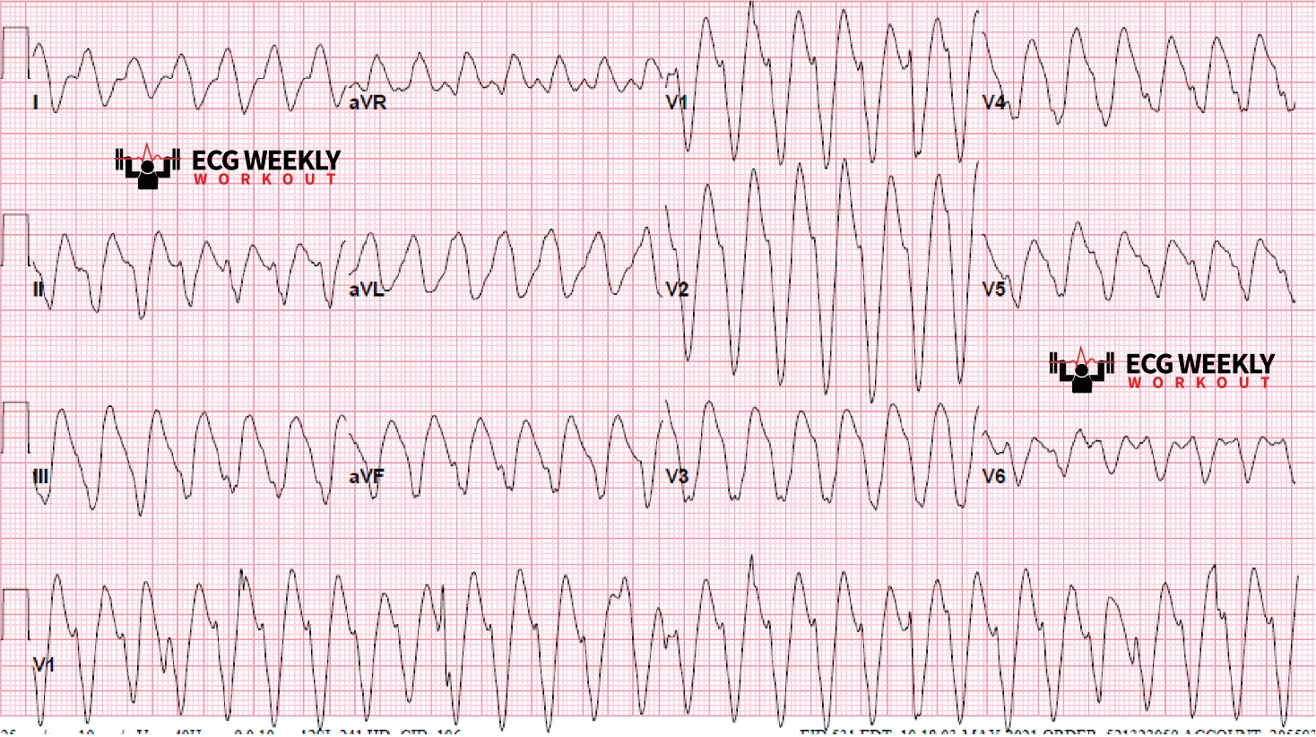 Presenting ECG — STAT ECG Diagnoses: a review of the differentials to consider when dealing with wide complex tachycardias and when antiarrhythmic medications can be harmful